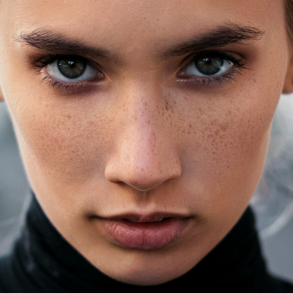 Dermal Filler Cheek