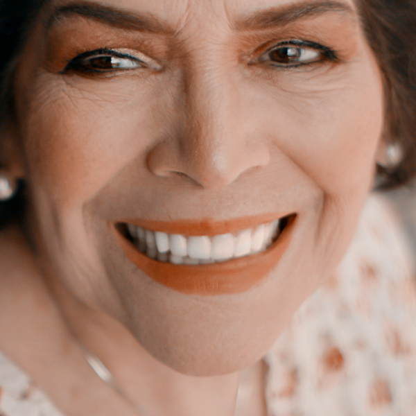 Dermal Filler Marionette Lines